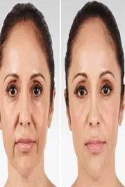 Beauty Tips: How To Tighten Skin On The Face And Neck5