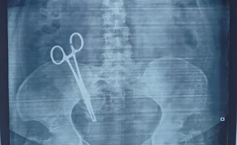 Scissors left in a woman stomach after a C-section removed after 17 years