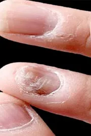Buldhana: Initially Hair Now Nails Are Shedding6