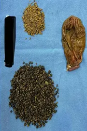 8125 Gallstones Removed from 70-Year-Old Man3