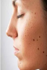 Beauty Tips: Non-Cancerous Mole Removal Beaumont Minor Surgeries7