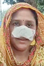 Bengal Man Bites Off And Swallows Wife Nose8