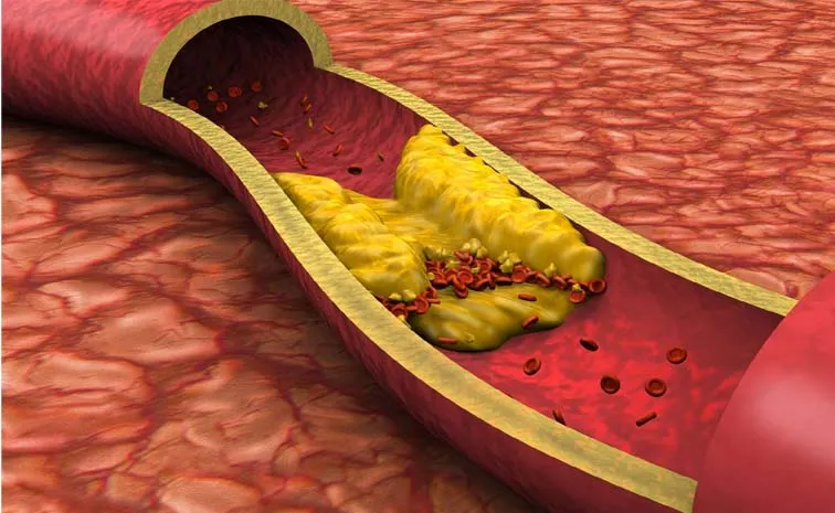 How to Remove Calcium Deposits from Arteries Naturally1