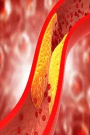 How to Remove Calcium Deposits from Arteries Naturally1