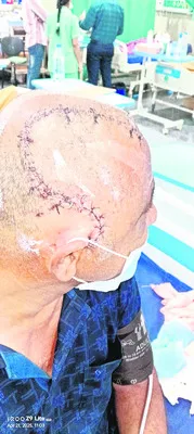 కోతుల దాడిలో గాయాలు.. వైద్యానికి రూ.4 లక్షలు