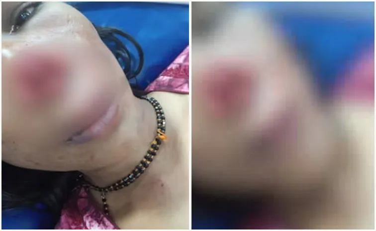 Man Bites Wife Nose Off During Fight Over Repaying Loan In Karnataka