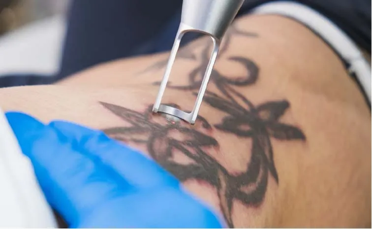 Tattoo Removal: How It Works Process Healing And Scarring