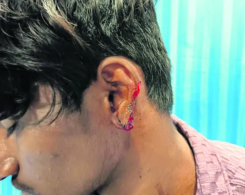 బైక్ అదుపు తప్పి వ్యక్తికి గాయాలు