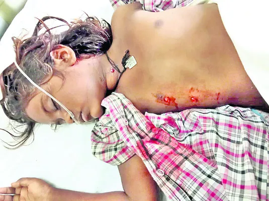 కుక్కల దాడిలో   బాలికకు గాయాలు 
