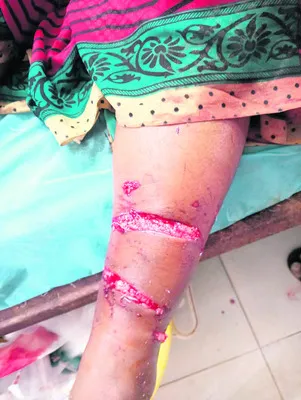వీధి కుక్కల దాడిలో 12 మంది గాయాలు 