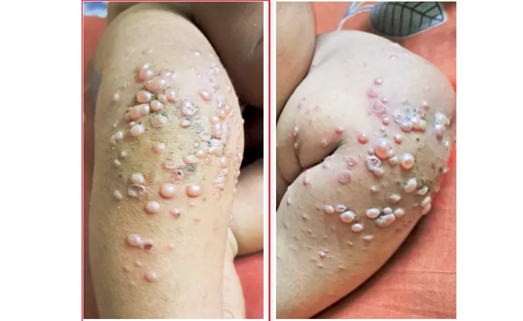 Viral infection in children in Penuganchiprolu Andhra Pradesh