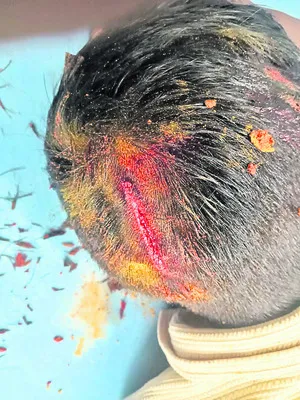 హాస్టల్ విద్యార్థి తలకు గాయం