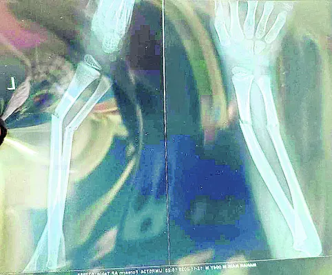 చేయి విరిగినా..  చలించలేదు! 
