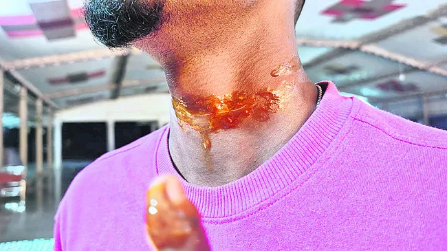 చైనా మాంజా గొంతుకు తగిలి గాయాలు