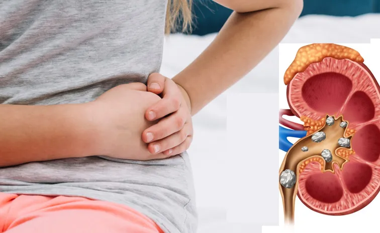 Kidney stones becoming more prevalent in children