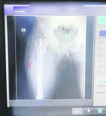 బోల్ట్‌ తొలగించమంటే బ్లేడు వదిలేసి కుట్టేశారు! 