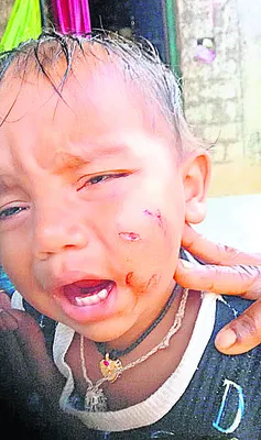 చిన్నారిపై పిచ్చి కుక్క దాడి 