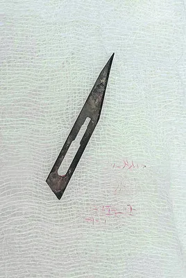 మహిళ శరీరంలో బ్లేడ్‌...