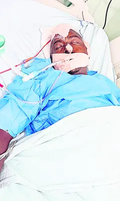 రోడ్డు ప్రమాదంలో కోమాలోకి కూలి