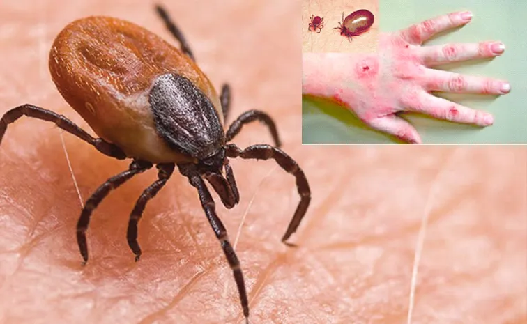Scrub typhus in two telugu states Signs and symptoms