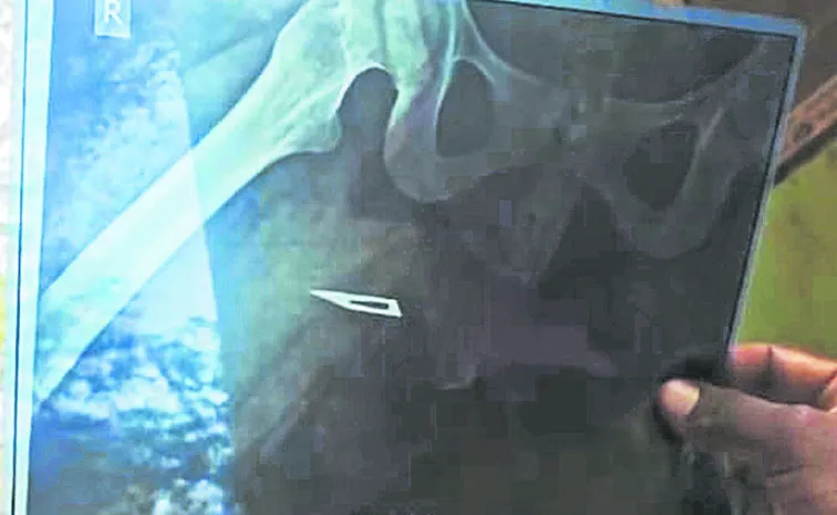 మహిళ శరీరంలో సర్జికల్‌ బ్లేడ్‌