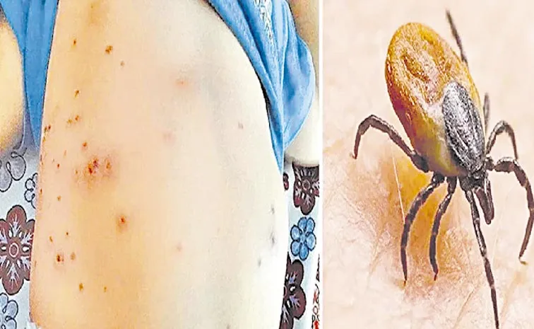 స్క్రబ్‌ టైఫస్‌తో 9 మంది మృతి