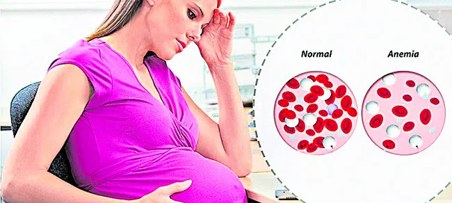 పోషకాహార లోపం.. గర్భిణులకు శాపం 