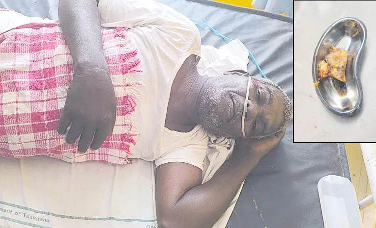 Chicken Bone Stuck in Throat Removed Safely