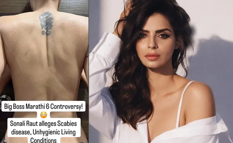 Bigg Boss Marathi 6 Sonali Raut Shares Video Of Severe Skin Infection