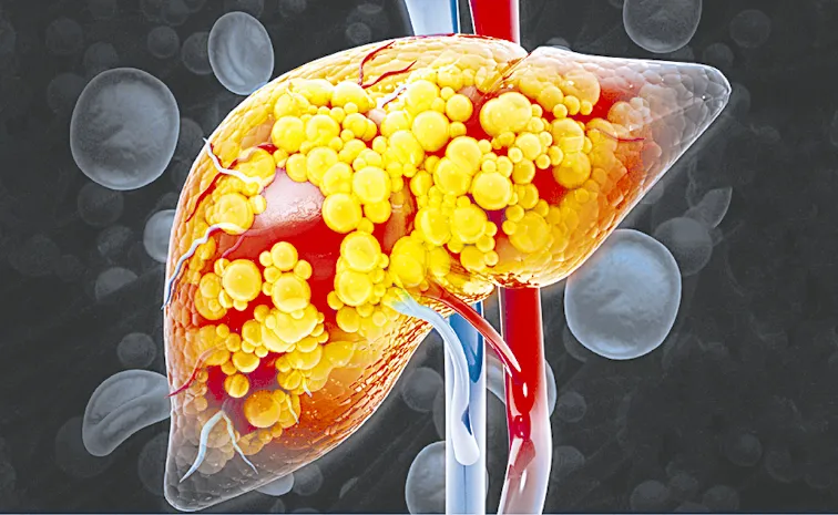 Liver Disease: excess fat builds up in liver cells