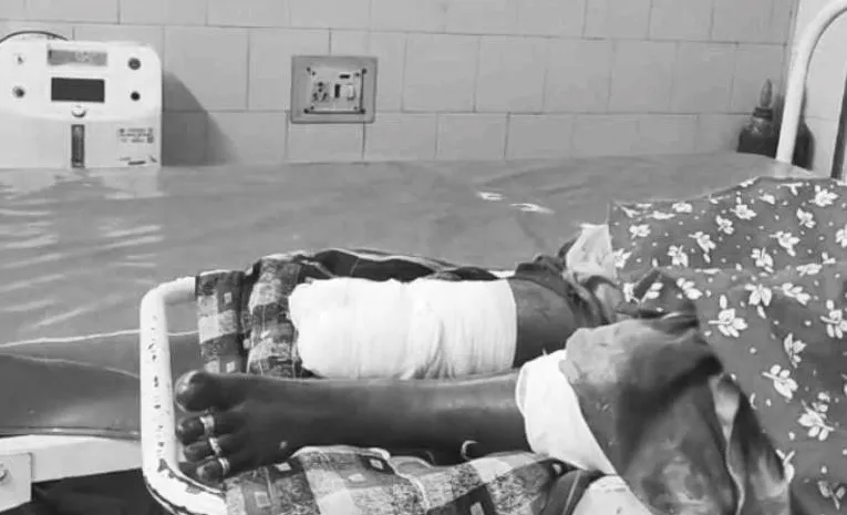 Husband Cuts Off Wife Leg in Suspicion