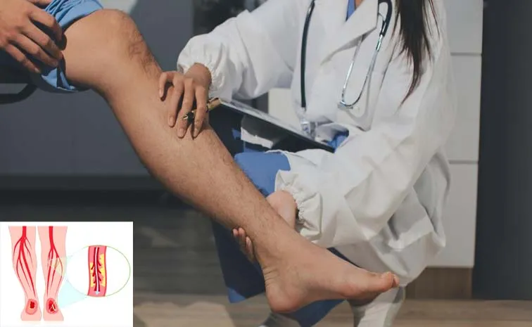 Health Tips: Peripheral artery disease Symptoms and causes