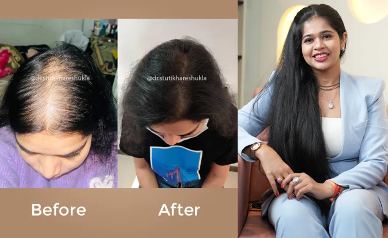 Hair Loss Truth Revealed Dr Stuti Khare Shukla Brings Non Surgical Hair Growth