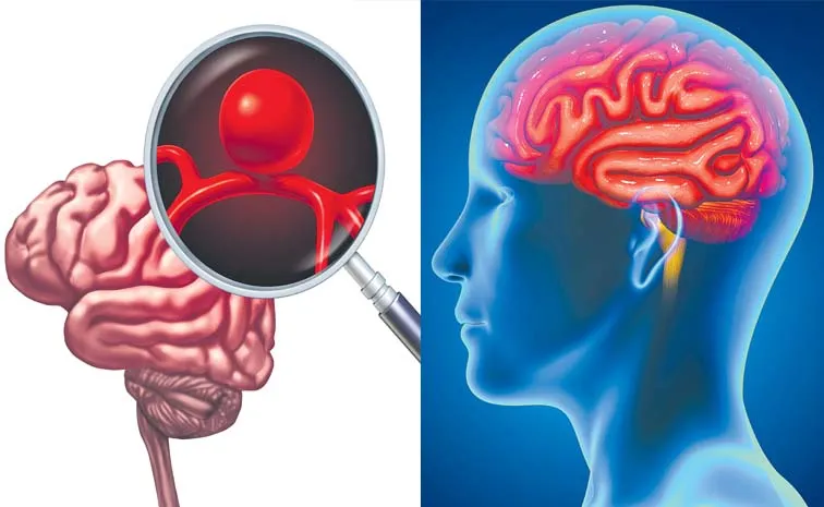 Brain Aneurysm Symptoms And Causes Health