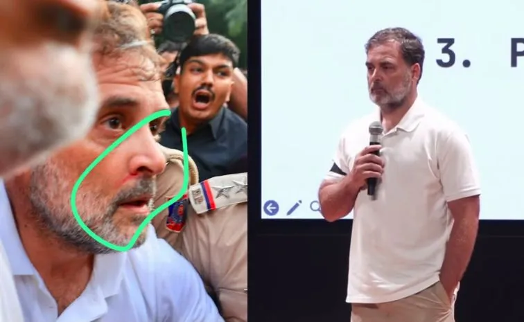  Congress MP Rahul Gandhi On Bleeding Nose 