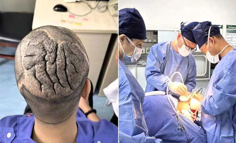 Chinese Man With Rare Brain-Like Scalp Condition