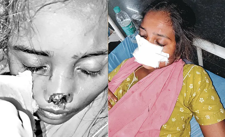 కాపురానికి రావడం లేదని.. భార్య ముక్కు కొరికిన భర్త!