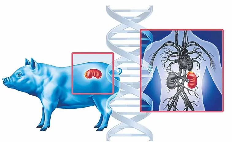 Transplantation of genetically modified pig kidney into a human