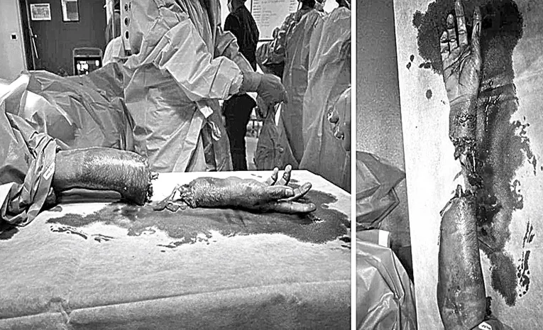 Care Hospital Hyderabad Successfully Replants Severed Forearm Of 19Year Old Youth